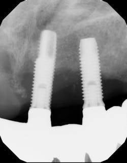 Radiograph of a patient who suffered from chronic periodontal disease and had all teeth replaced with implants. The patient is now suffering from advanced peri-implantitis. Radiograph of a patient who suffered from chronic periodontal disease and had all teeth replaced with implants. The patient is now suffering from advanced peri-implantitis.