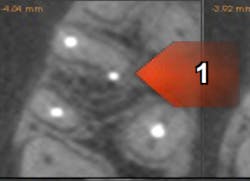 Figure 1: CBCT showing root perforation after endodontic therapy on the mesial buccal root of no. 3 Figure 1: CBCT showing root perforation after endodontic therapy on the mesial buccal root of no. 3