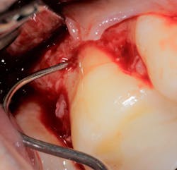 Figure 3: Clinical entry showing more than 50% of bone on the distal and palatal of no. 3 Figure 3: Clinical entry showing more than 50% of bone on the distal and palatal of no. 3