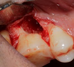 Figure 4: Root amputation and removal of MB root with bevel and polishing of furcation Figure 4: Root amputation and removal of MB root with bevel and polishing of furcation