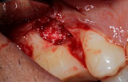 Figure 5: Graft of defect with Bio-Oss Collagen for structural support Figure 5: Graft of defect with Bio-Oss Collagen for structural support