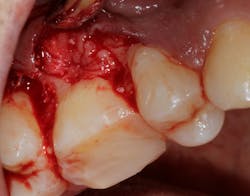 Figure 6: Addition of Bio-PRF to promote angiogenesis and upregulate the healing cascade Figure 6: Addition of Bio-PRF to promote angiogenesis and upregulate the healing cascade