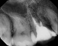 Figure 8: Periapical of bone fill in mesial buccal root one year after graft Figure 8: Periapical of bone fill in mesial buccal root one year after graft