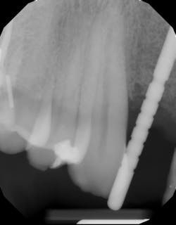 Figure 1: Radiograph of pin index after initial osteotomy, showing off-angulation toward distal Figure 1: Radiograph of pin index after initial osteotomy, showing off-angulation toward distal