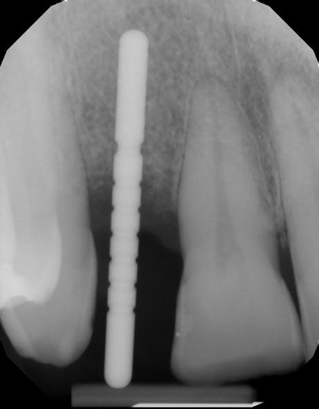 Figure 2: Radiograph of angulation correction with twist drill, showing incomplete bodily correction of osteotomy