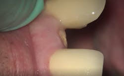 Figure 1: Clinical presentation of fractured maxillary lateral incisor Figure 1: Clinical presentation of fractured maxillary lateral incisor