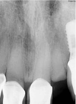 Figure 2: Pre-op clinical radiograph of no. 10 with oblique fracture to osseous crest Figure 2: Pre-op clinical radiograph of no. 10 with oblique fracture to osseous crest