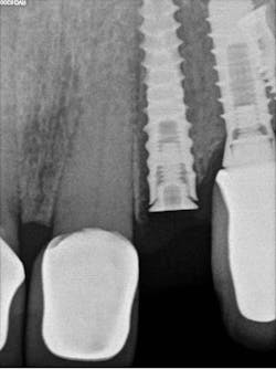 Figure 4: Postoperative radiograph Figure 4: Postoperative radiograph