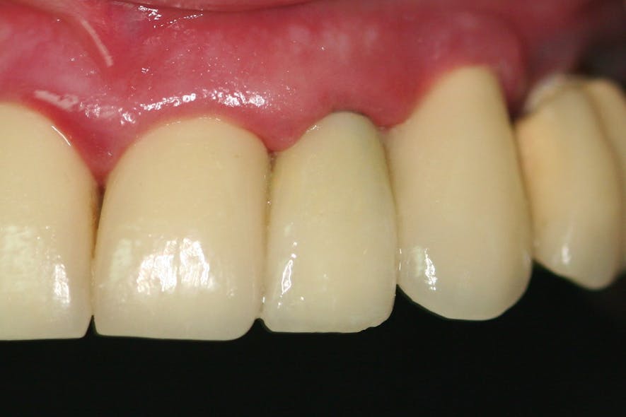 Figure 6: Final restoration in the mouth