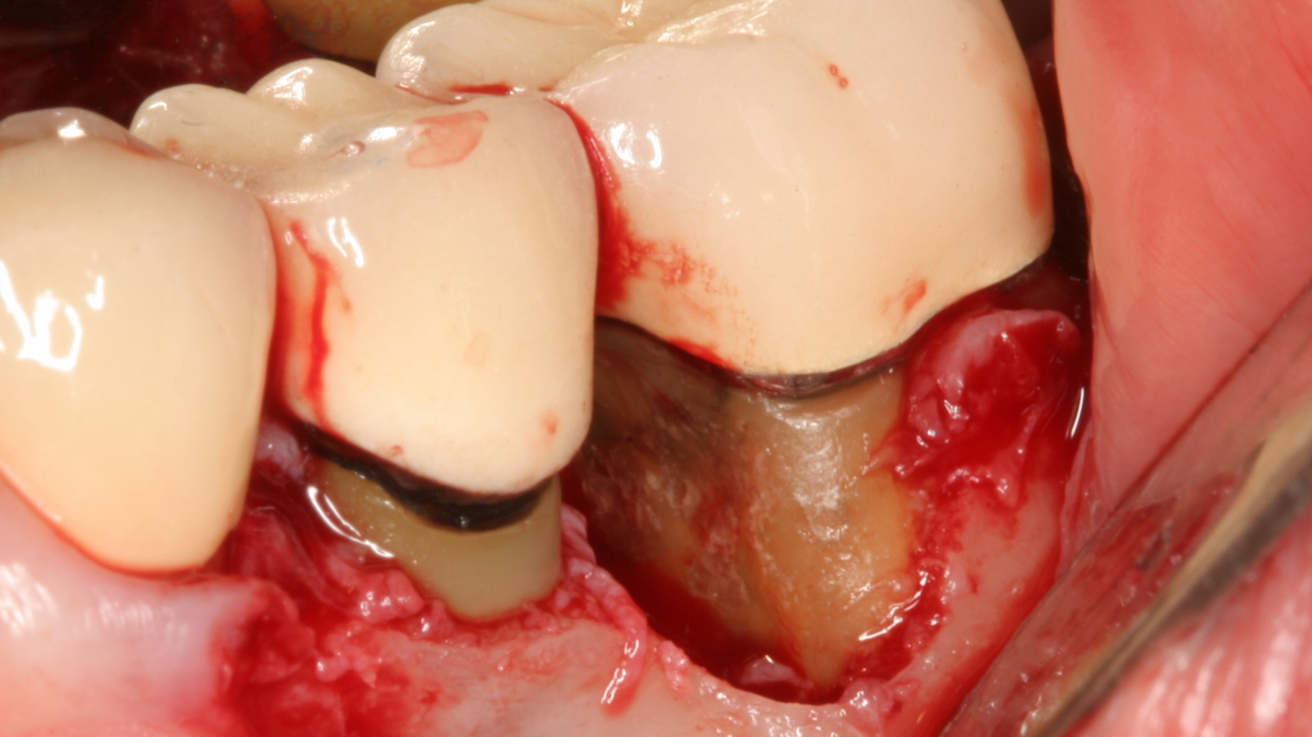 Figure7 Surgery Burnished Calculus 60de3969200de