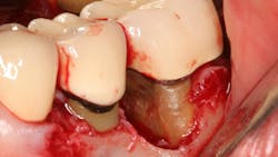 Figure7 Surgery Burnished Calculus 60de3969200de Figure7 Surgery Burnished Calculus 60de3969200de