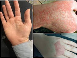 Figure 1: Common side effects from hand sanitizer overuse Figure 1: Common side effects from hand sanitizer overuse