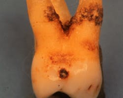 Figure 1: Subgingival root planing reached only a portion of the calculus in this molar with a furcation involvement. Figure 1: Subgingival root planing reached only a portion of the calculus in this molar with a furcation involvement.