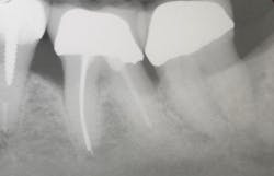 Figure 4: Radiographs taken at the time of initial scaling and root planing revealed early bone loss on the mesial and distal of the first molar.