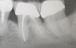 Figure 4: Radiographs taken at the time of initial scaling and root planing revealed early bone loss on the mesial and distal of the first molar. Figure 4: Radiographs taken at the time of initial scaling and root planing revealed early bone loss on the mesial and distal of the first molar.