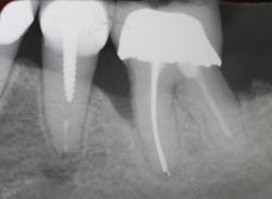 Figure 5: Five years later, a presurgical radiograph reveals a severe bone defect on the mesial of the first molar and a healed second molar extraction site. Figure 5: Five years later, a presurgical radiograph reveals a severe bone defect on the mesial of the first molar and a healed second molar extraction site.