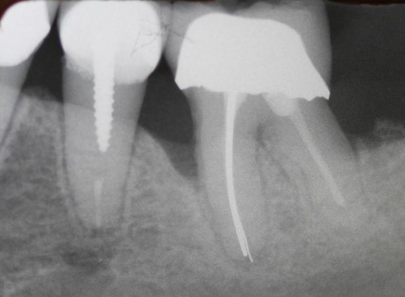 Figure 5: Five years later, a presurgical radiograph reveals a severe bone defect on the mesial of the first molar and a healed second molar extraction site.