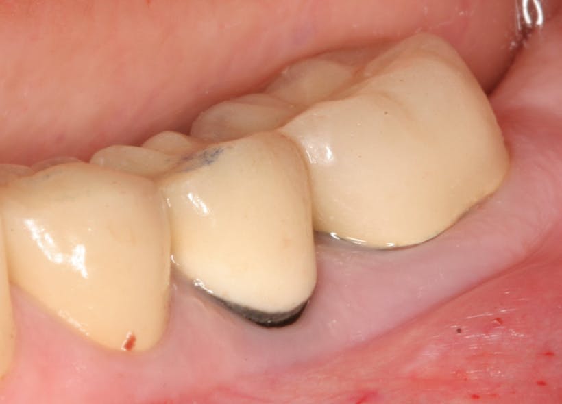 Figure 6: The gingival tissues were not inflamed prior to periodontal surgery.