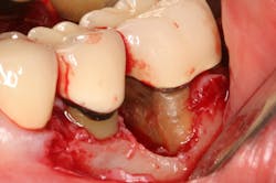 Figure 7: Flap reflection revealed extensive burnished calculus that could not be detected by a periodontal probe. Figure 7: Flap reflection revealed extensive burnished calculus that could not be detected by a periodontal probe.