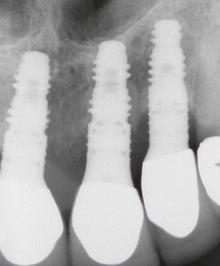Figure 8: Peri-implantitis progressed at a similar rate to that of periodontitis in the same patient.