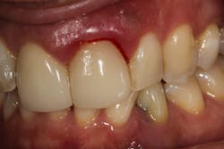 Figure 1: Gum bleeding after a dental cleaning
