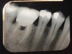 Figure 3: Crown margin difficult to clean into the molar furcation Figure 3: Crown margin difficult to clean into the molar furcation