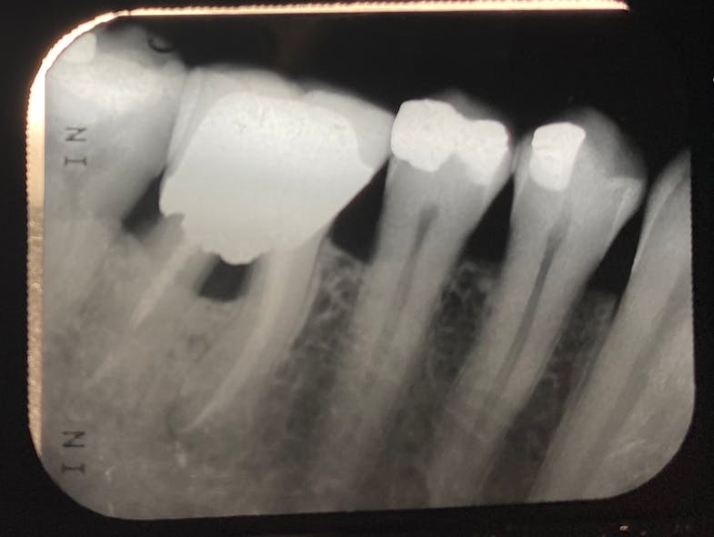 Figure 3: Crown margin difficult to clean into the molar furcation