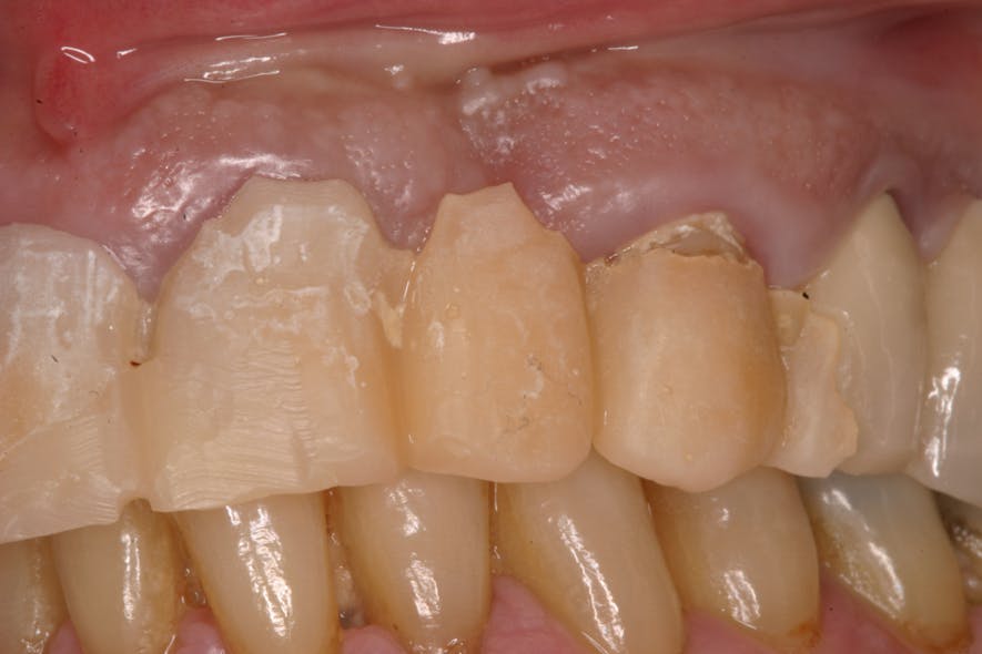 Figure 2: Poorly contoured implant and natural tooth temporaries leading to tissue and occlusal problems at the time of final insertion