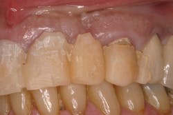 Figure 2: Poorly contoured implant and natural tooth temporaries leading to tissue and occlusal problems at the time of final insertion