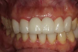 Figure 3: Tissue profile developed with temporaries to contour tissue for the final restoration Figure 3: Tissue profile developed with temporaries to contour tissue for the final restoration