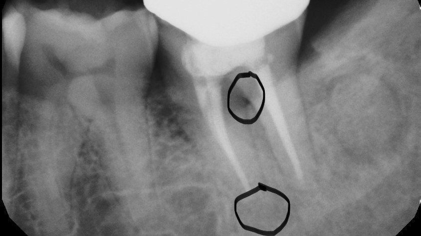 Tooth Pain After Root Canal Therapy The 5 Common Causes Perio   Figure2.615df44fed834 