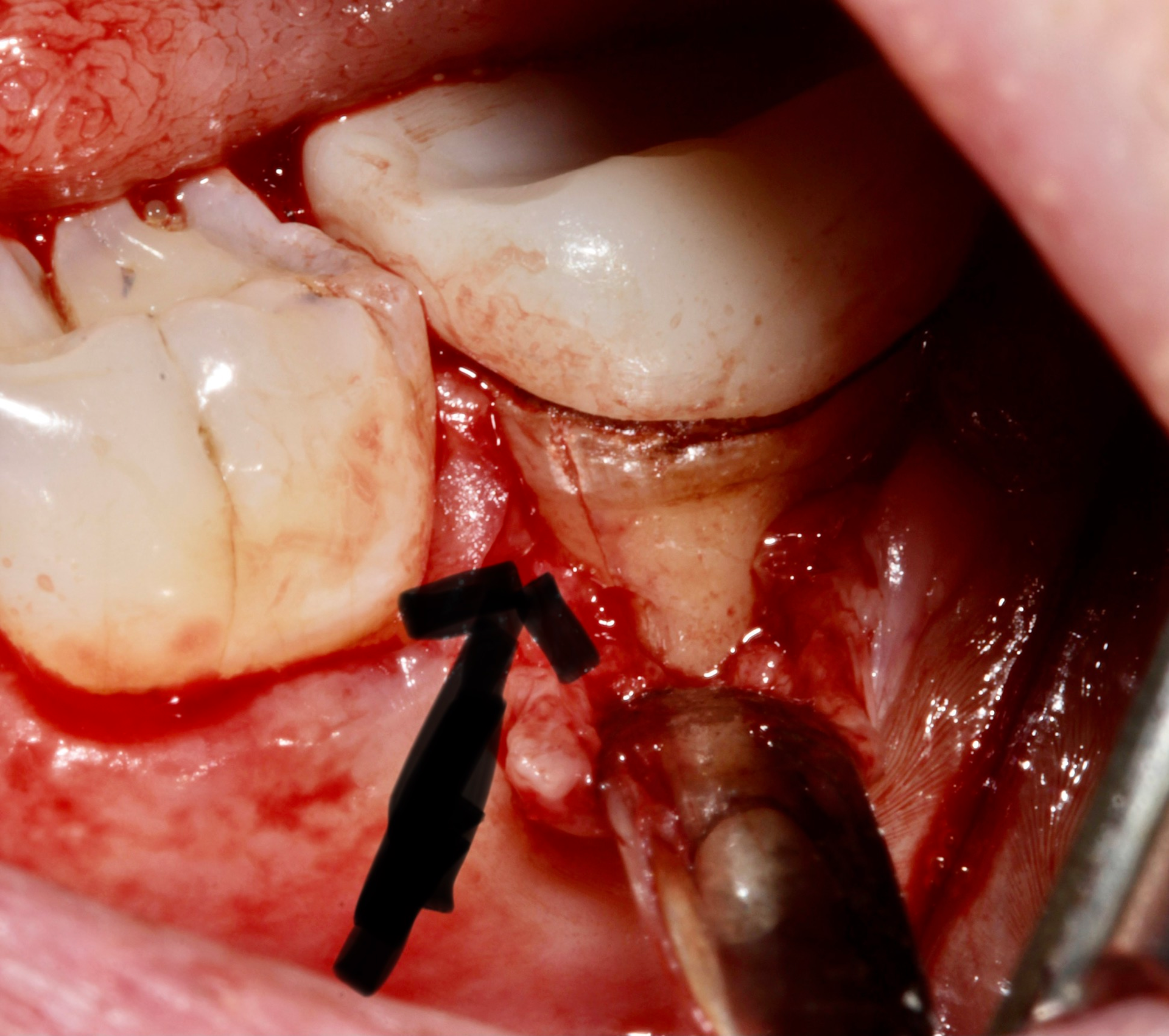 Root Canal Front Tooth