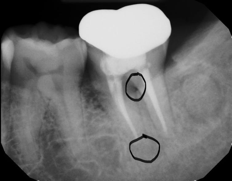 Figure 2: A tooth with both a periodontal and endodontic lesion