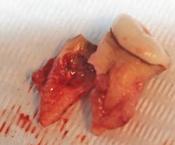 Figure 3: Removal of a tooth with a root canal due to fracture. This patient remained in pain after that endodontic therapy. Figure 3: Removal of a tooth with a root canal due to fracture. This patient remained in pain after that endodontic therapy.