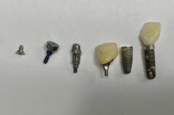 Figure 1: There are many components to the dental implant including a cover screw, healing abutment, abutment, crown, abutment screw, and finally the implant fixture screw itself. Any of these can fall out of the mouth.