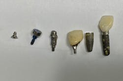 Figure 1: There are many components to the dental implant including a cover screw, healing abutment, abutment, crown, abutment screw, and finally the implant fixture screw itself. Any of these can fall out of the mouth. Figure 1: There are many components to the dental implant including a cover screw, healing abutment, abutment, crown, abutment screw, and finally the implant fixture screw itself. Any of these can fall out of the mouth.