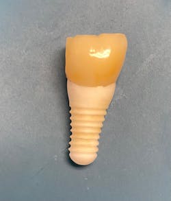 Figure 2: Example of an exfoliated dental implant, which is the entire dental implant/abutment crown complex