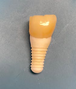 Figure 2: Example of an exfoliated dental implant, which is the entire dental implant/abutment crown complex Figure 2: Example of an exfoliated dental implant, which is the entire dental implant/abutment crown complex