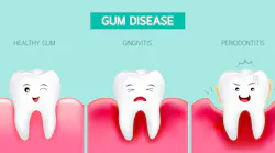 gum disease, periodontal disease, periodontitis, oral health