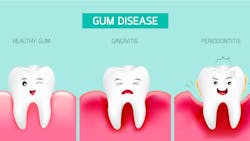 gum disease, periodontal disease, periodontitis, oral health
