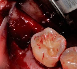 Figure 1: Patient with excessive bleeding after tooth extraction due to having von Willebrand disease Figure 1: Patient with excessive bleeding after tooth extraction due to having von Willebrand disease