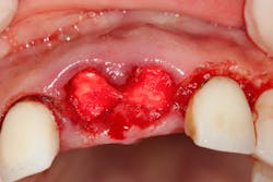 Figure 2: Extraction socket packed with HeliPlug in a patient on Coumadin for deep vein thrombosis with a tendency to have excessive bleeding. Figure 2: Extraction socket packed with HeliPlug in a patient on Coumadin for deep vein thrombosis with a tendency to have excessive bleeding.