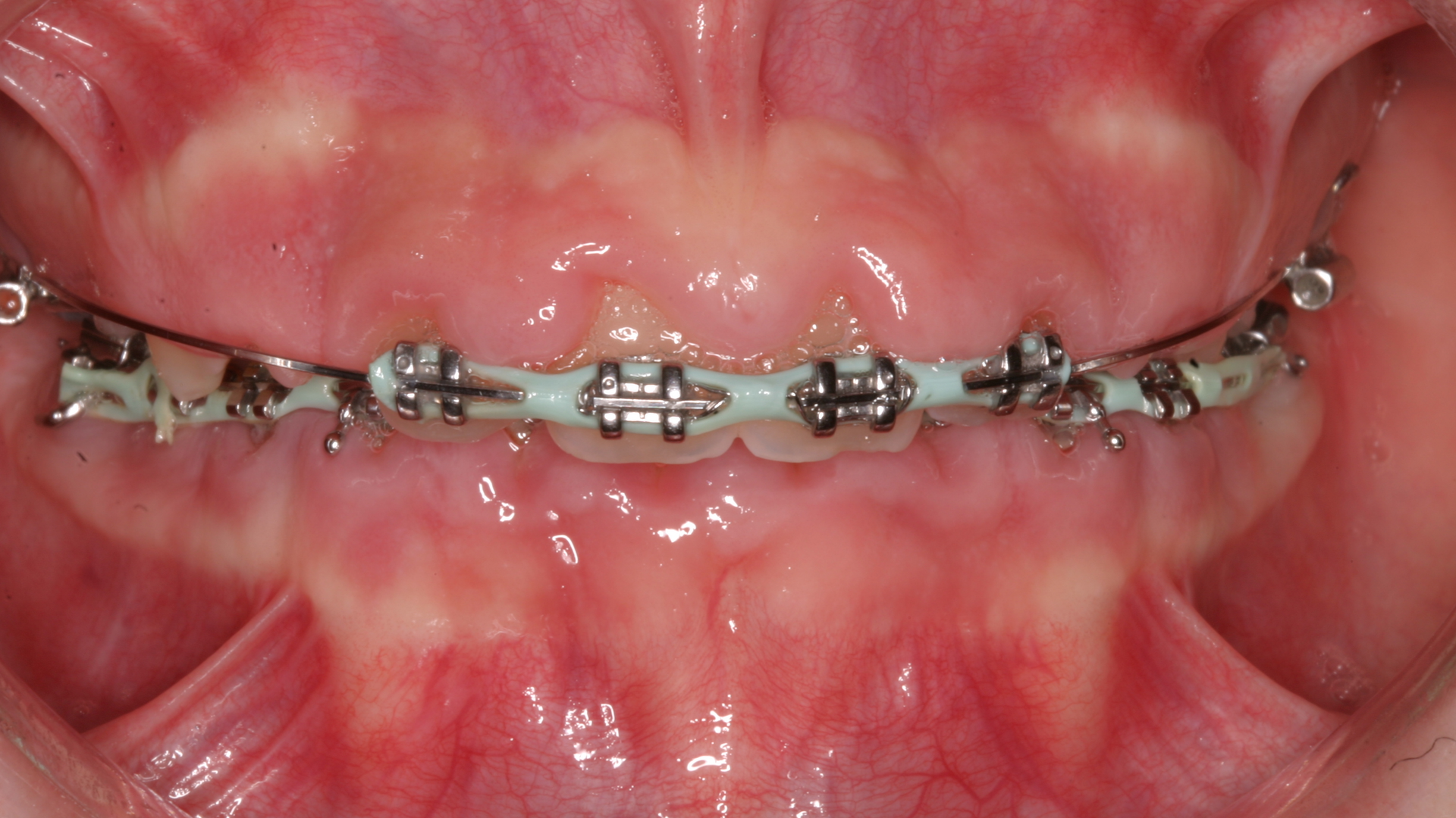Fig2 Ge Caused By Ortho 61d7685720fe6