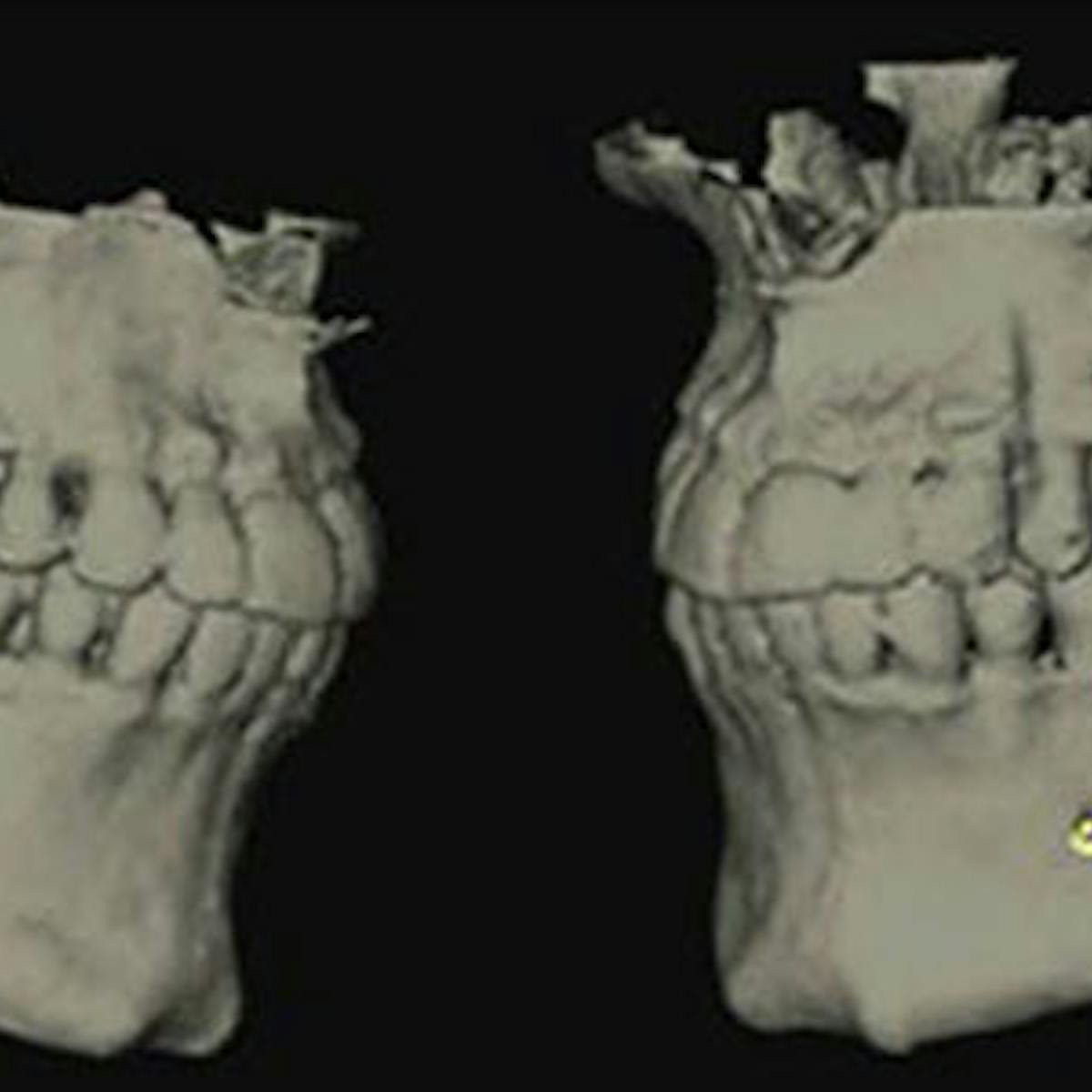 Fig 2 Bifid And Trifid Canal Image Fig 2 Bifid And Trifid Canal Image