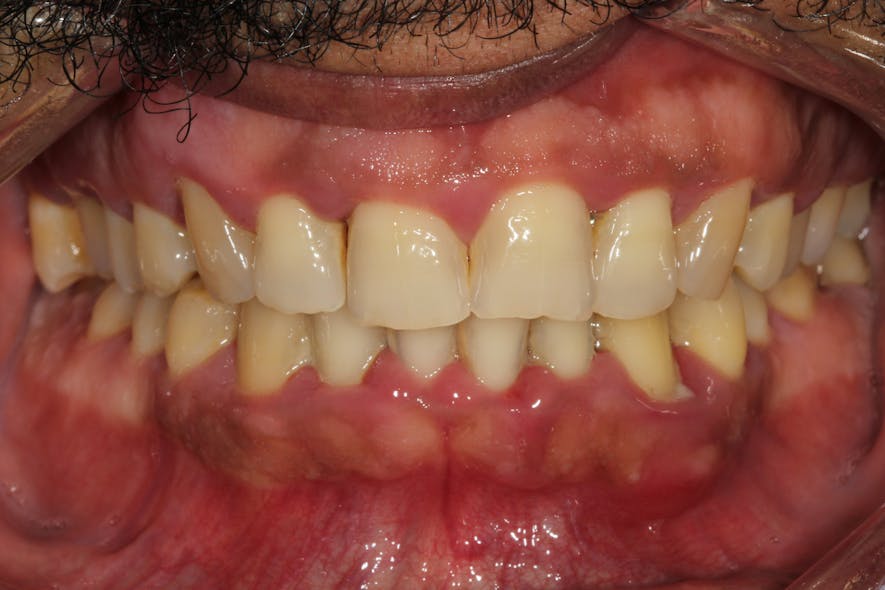 Figure 1: Gum tissue inflammation caused by bacteria, leading to gum disease and the appearance of swollen gums
