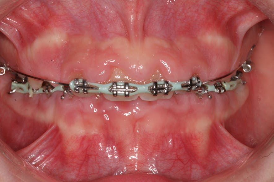 Figure 2: Gummy smile caused by a combination of poor oral hygiene and orthodontics exacerbating bacterial accumulation