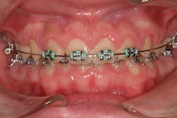 Figure 2a: Correction of a gummy smile after removal of excess gum tissue with the Solea dental laser Figure 2a: Correction of a gummy smile after removal of excess gum tissue with the Solea dental laser