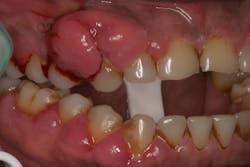 Figure 3: Gingival overgrowth caused by a combination of the patient being on phenytoin and having poor oral hygiene Figure 3: Gingival overgrowth caused by a combination of the patient being on phenytoin and having poor oral hygiene