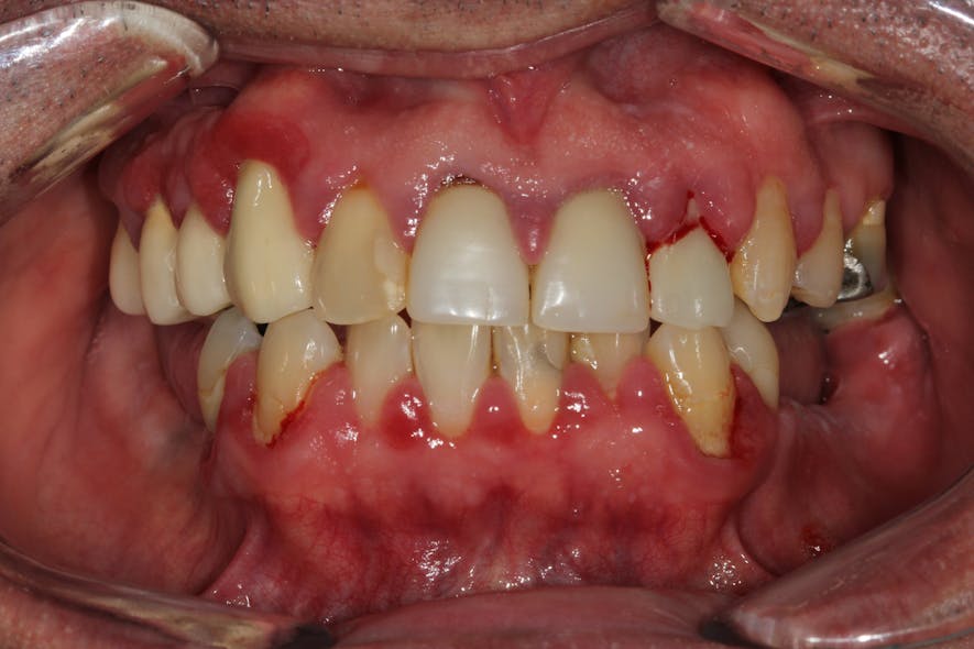 Figure 4a: Gingival overgrowth caused by a patient being on nifedipine and having poor oral hygiene