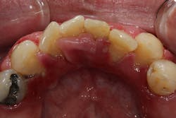 Figure 4b: Gingival overgrowth caused by a patient being on nifedipine and having poor oral hygiene